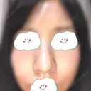 鼻尖形成（切開） / 軟骨移植 白山クリニック 大分 DAY 21 サムネイル用