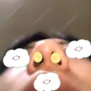 鼻尖形成（切開） / 軟骨移植 白山クリニック 大分 DAY 21 サムネイル用