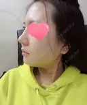 隆鼻術 / 鼻尖形成（切開） / 糸リフト / 骨削り（エラ） / 骨削り（頬） / 脂肪吸引（顔） RG整形外科（旧リオン整形外科） DAY 11 サムネイル用