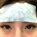 二重埋没 湘南美容歯科 大阪心斎橋院 DAY 0 サムネイル用