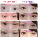 二重埋没 / 上まぶたの脂肪取り TCB東京中央美容外科 江坂院 AFTER サムネイル用