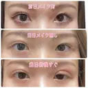 二重埋没 / 上まぶたの脂肪取り TCB東京中央美容外科 江坂院 DAY 6 サムネイル用