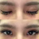 二重埋没 湘南美容歯科 大阪心斎橋院 DAY 1 サムネイル用