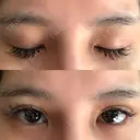 二重埋没 湘南美容歯科 大阪心斎橋院 DAY 2 サムネイル用