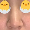 鼻尖形成（切開） / 鼻尖縮小 / ヒアルロン酸注入（鼻） 東京ヒルズクリニック 新宿院 DAY 59 サムネイル用