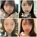 ボトックス（あご） / ヒアルロン酸注入（あご） / ボトックス（エラ・小顔） / 脂肪溶解注射（顔） クリニックA.O. DAY 20 サムネイル用