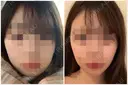 ボトックス（あご） / ヒアルロン酸注入（あご） / ボトックス（エラ・小顔） / 脂肪溶解注射（顔） クリニックA.O. AFTER サムネイル用