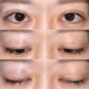 眼瞼下垂（切開） / その他（目元） / 目尻切開 / 自然癒着法 POP美容整形クリニック DAY 40 サムネイル用