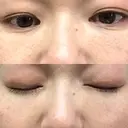 下まぶたたるみ取り セオリークリニック DAY 72 サムネイル用