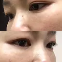 下まぶたたるみ取り セオリークリニック DAY 72 サムネイル用