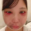 骨削り（頬） / 脂肪吸引（顔） / ボトックス（エラ・小顔） / ボトックス（ふくらはぎ） / ヒアルロン酸注入（額） / ボトックス（肩） RG整形外科（旧リオン整形外科） DAY 3 サムネイル用