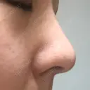 スレッドノーズ キップン整形外科 DAY 1 サムネイル用