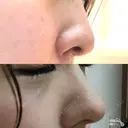 スレッドノーズ キップン整形外科 DAY 0 サムネイル用