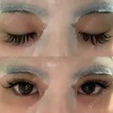 二重埋没 湘南美容歯科 大阪心斎橋院 DAY 4 サムネイル用