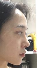 二重埋没 / 隆鼻術 / 豊胸（シリコンバッグ） MIGO（ミゴ）整形外科 DAY 14 サムネイル用