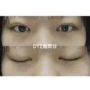 二重埋没 マーブル美容整形外科 DAY 15 サムネイル用
