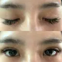 二重埋没 湘南美容歯科 大阪心斎橋院 AFTER サムネイル用