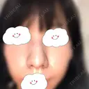 鼻尖形成（切開） / 軟骨移植 白山クリニック 大分 DAY 28 サムネイル用