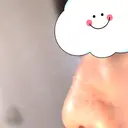 鼻尖形成（切開） / 軟骨移植 白山クリニック 大分 DAY 28 サムネイル用