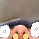 鼻尖形成（切開） / 軟骨移植 白山クリニック 大分 DAY 28 サムネイル用