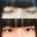 二重埋没 共立美容外科 大分院 DAY 0 サムネイル用