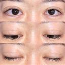 眼瞼下垂（切開） / その他（目元） / 目尻切開 / 自然癒着法 POP美容整形クリニック DAY 43 サムネイル用