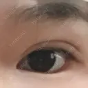 二重埋没 メディカルビューティセンター DAY 0 サムネイル用