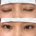 二重埋没 共立美容外科 大分院 DAY 1 サムネイル用