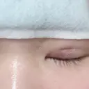 二重埋没 メディカルビューティセンター AFTER サムネイル用