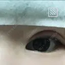 二重埋没 メディカルビューティセンター DAY 1 サムネイル用