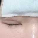 二重埋没 メディカルビューティセンター DAY 1 サムネイル用