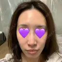 鼻尖形成（切開） / ヒアルロン酸注入（鼻） 東京ヒルズクリニック 新宿院 DAY 11 サムネイル用