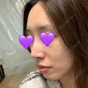 鼻尖形成（切開） / ヒアルロン酸注入（鼻） 東京ヒルズクリニック 新宿院 DAY 11 サムネイル用