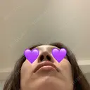 鼻尖形成（切開） / ヒアルロン酸注入（鼻） 東京ヒルズクリニック 新宿院 DAY 11 サムネイル用