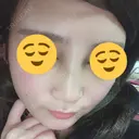 隆鼻術 たにまちクリニック DAY 7 サムネイル用