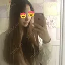 隆鼻術 / 鼻尖形成（切開） / 鼻中隔延長（切開） / 鼻孔縁挙上 ソウルリスタ整形外科 DAY 9 サムネイル用