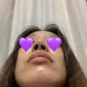 鼻尖形成（切開） / ヒアルロン酸注入（鼻） 東京ヒルズクリニック 新宿院 DAY 12 サムネイル用