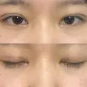 二重埋没 共立美容外科 大分院 DAY 4 サムネイル用