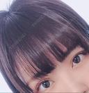 二重埋没 湘南美容クリニック 京都院 DAY 13 サムネイル用