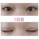 二重埋没 青山セレスクリニック 青山院 DAY 1 サムネイル用