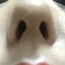 スレッドノーズ キップン整形外科 AFTER サムネイル用