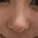 スレッドノーズ キップン整形外科 DAY 6 サムネイル用