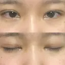 二重埋没 共立美容外科 大分院 AFTER サムネイル用