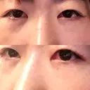 下まぶたの脂肪取り 品川美容外科 渋谷院（※品川スキンクリニック提携） DAY 0 サムネイル用