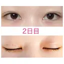 二重埋没 青山セレスクリニック 青山院 DAY 2 サムネイル用