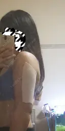 脂肪吸引（二の腕） プチパーティー医院 DAY 3 サムネイル用