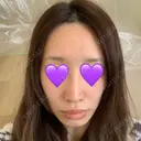 鼻尖形成（切開） / ヒアルロン酸注入（鼻） 東京ヒルズクリニック 新宿院 AFTER サムネイル用