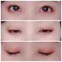 二重埋没 / 眼瞼下垂（切開） / クマ治療 / 下まぶたの脂肪取り THE MEDICAL SALON DAY 103 サムネイル用