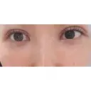 二重切開 CLASSY 仙台美容外科・美容皮膚科 AFTER サムネイル用