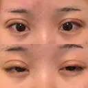 二重切開 大阪梅田中央クリニック美容外科 DAY 11 サムネイル用